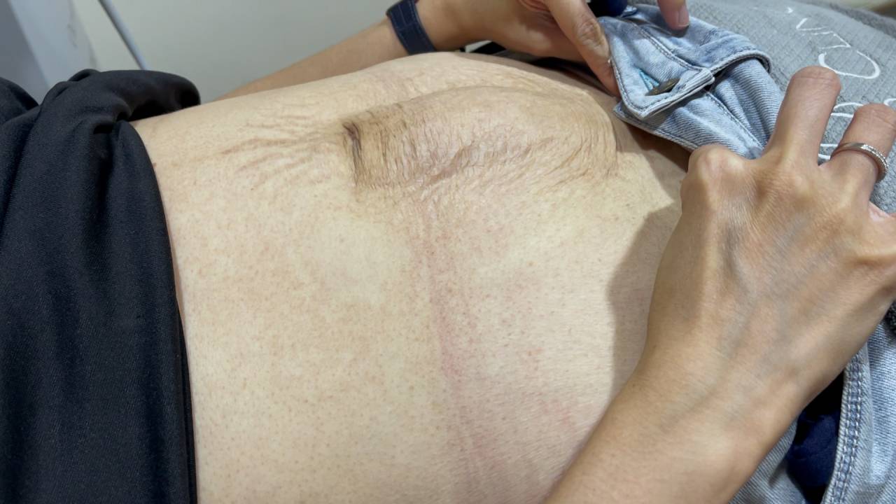 Abdominal irregular shape