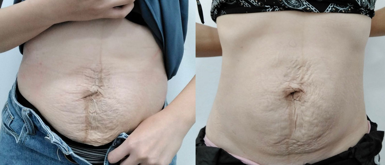 Diastasis Recti before and after case 3