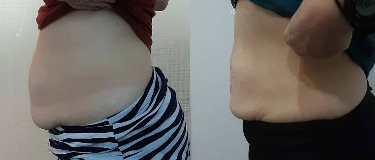 Diastasis Recti before and after case 1