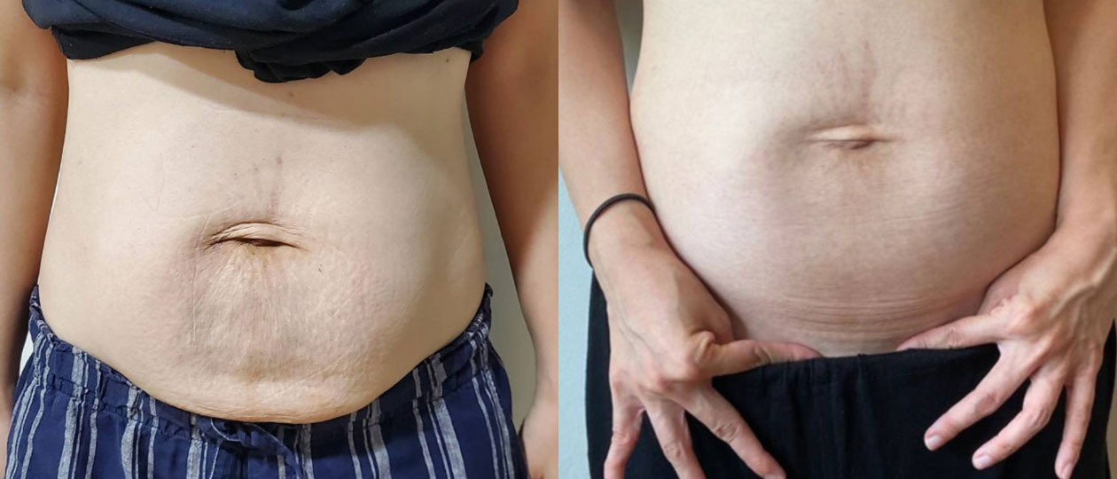 Diastasis Recti before and after case 2