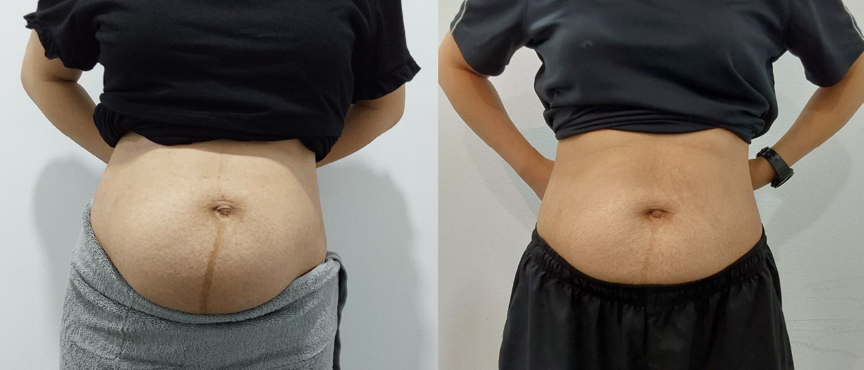 Diastasis Recti before and after case 5