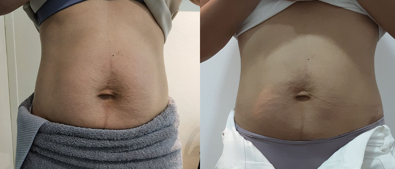 Diastasis Recti before and after case 4